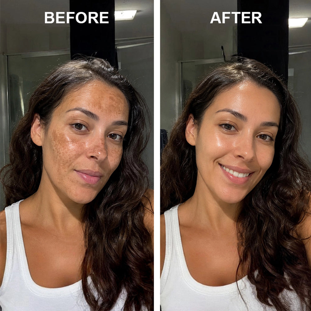 Hormonal Melasma Cream