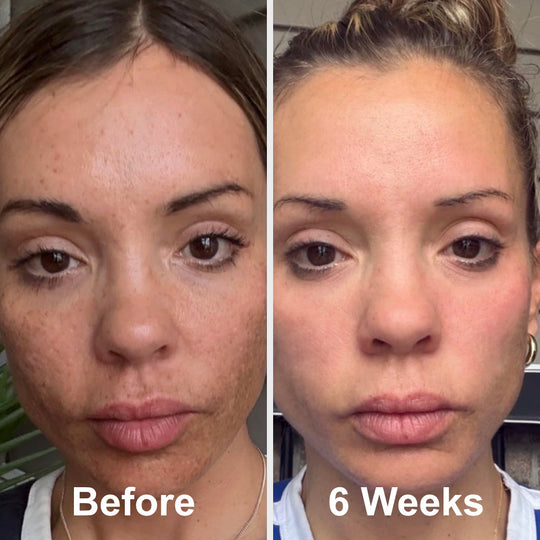 Prep - Gentle Melasma Cleanser