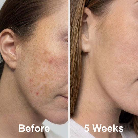 Prep - Gentle Melasma Cleanser