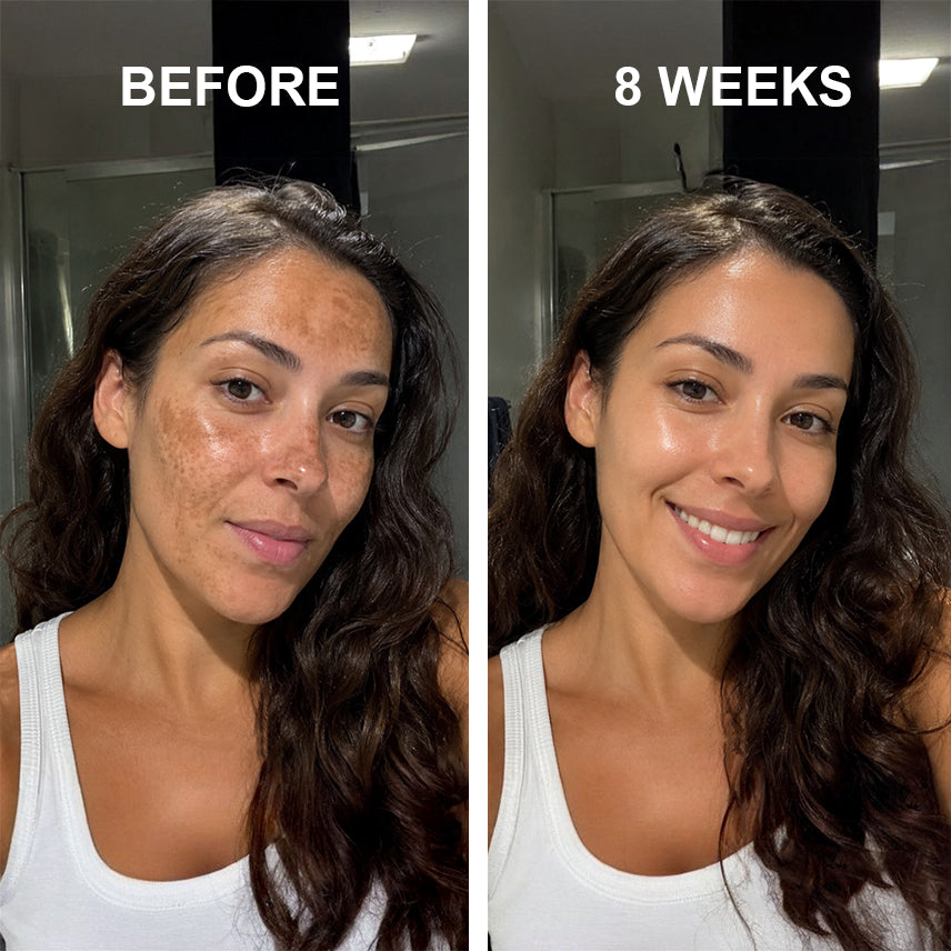 Melasma Recovery Cream