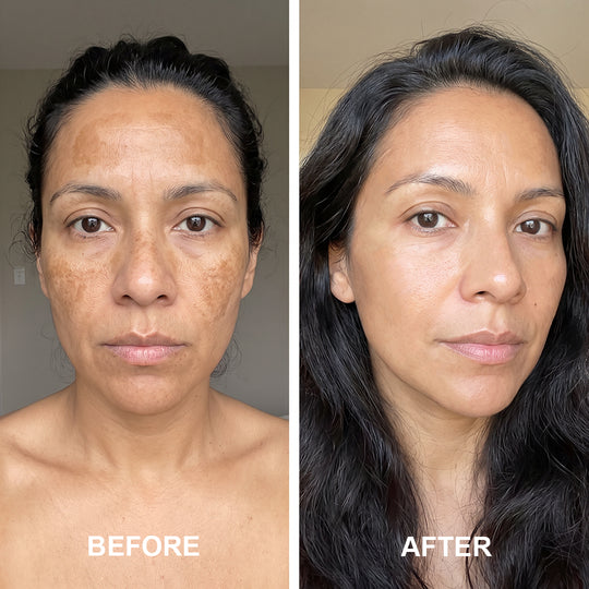 Arbutin 7% + Tranexamic Acid 4% Cream