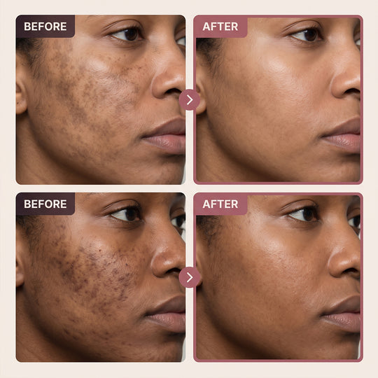 Arbutin 7% + Tranexamic Acid 4% Cream